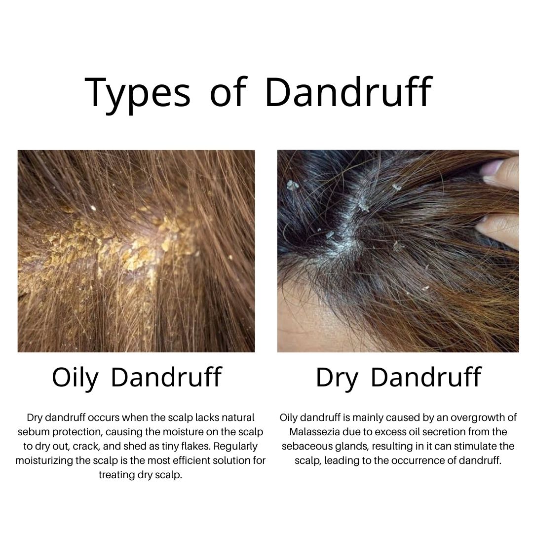 Dandruff
