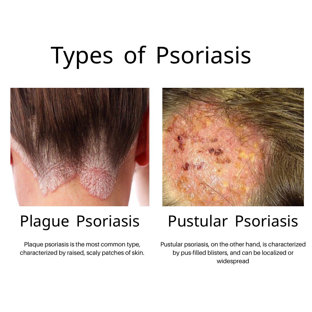 Psoriasis