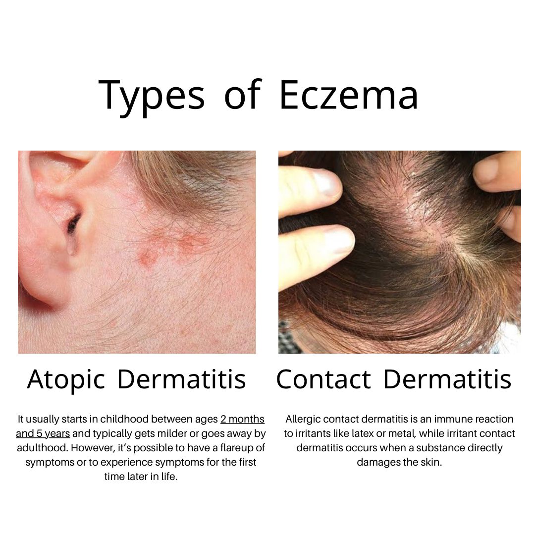 Eczema