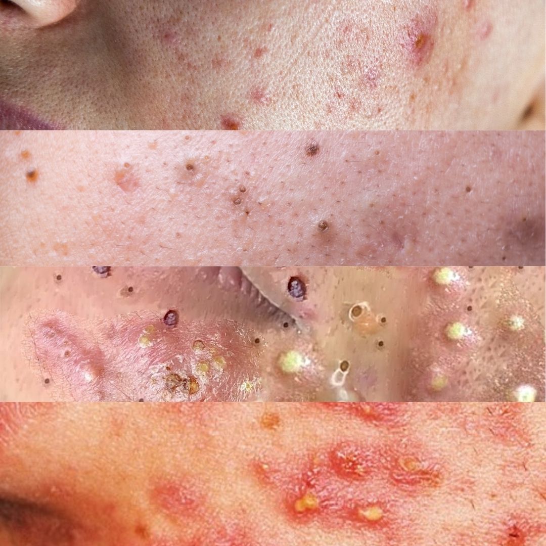 Acne