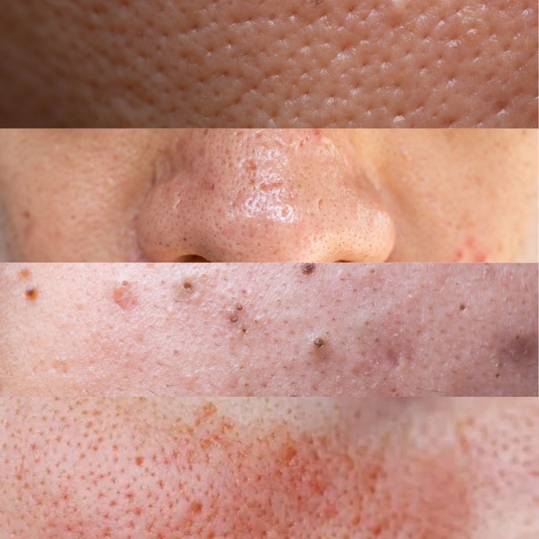 Pores