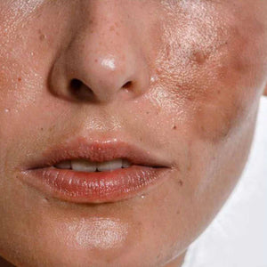 Dull & Uneven Skin