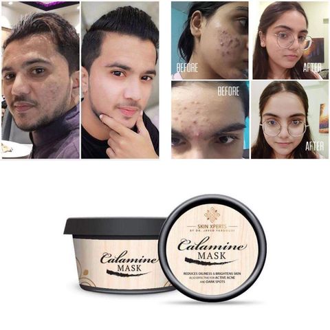 Calamine Mask – Dr Javed Farooqui