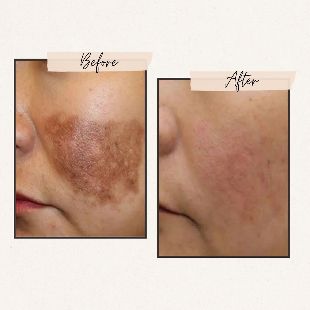 Miracle Advance Brightening Cream with Arbutin & Niacinamide Complex